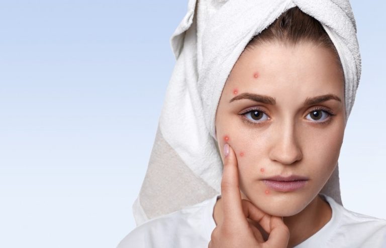 মুখে ব্রণ দূর করার উপায়