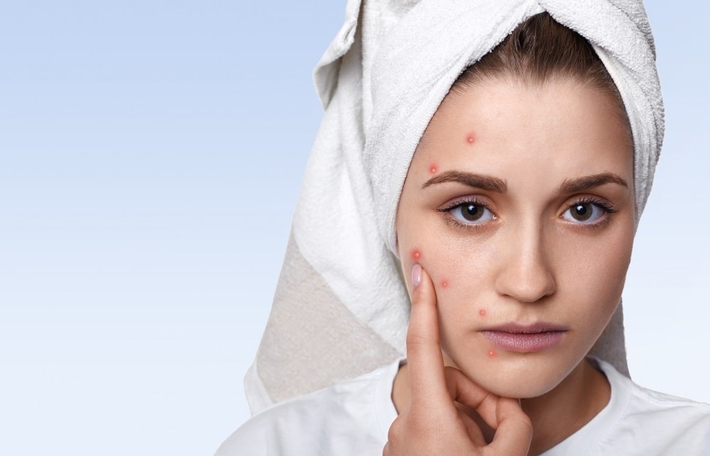 মুখে ব্রণ দূর করার উপায়